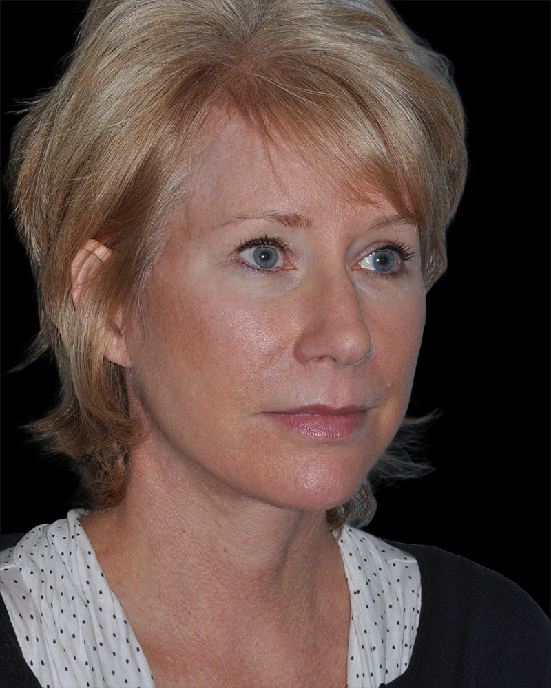 Facelift Before & After Patient #9135