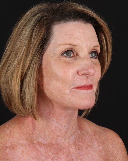 Facelift Before & After Patient #8944
