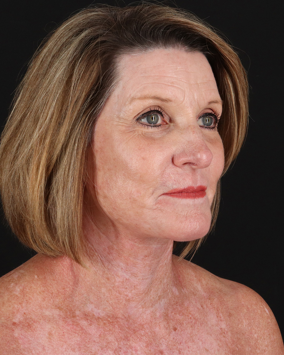 Facelift Before & After Patient #8944
