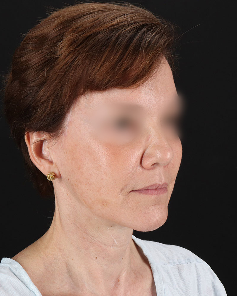 Facelift Before & After Patient #9173