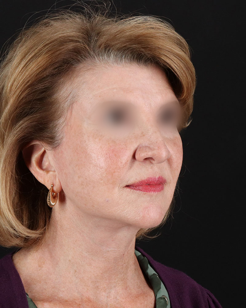 Facelift Before & After Patient #9140