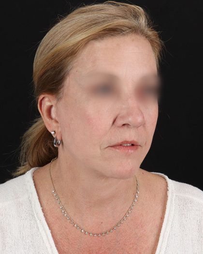 Facelift Before & After Patient #8957