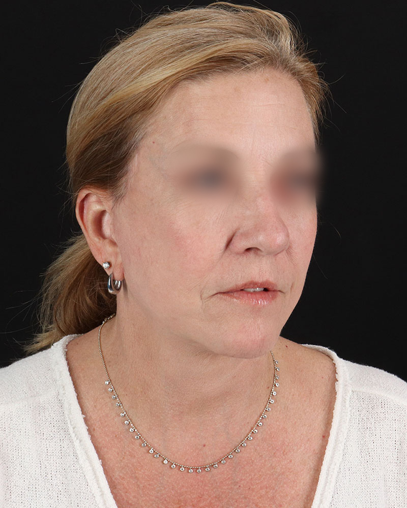 Facelift Before & After Patient #8957