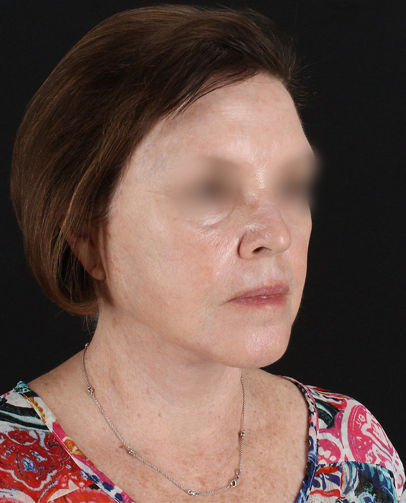 Facelift Before & After Patient #8954