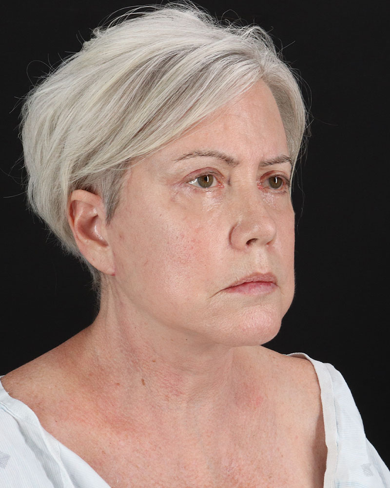 Facelift Before & After Patient #8946