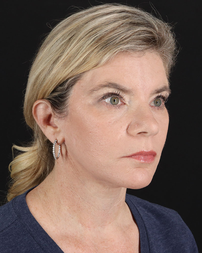 Facelift Before & After Patient #8947