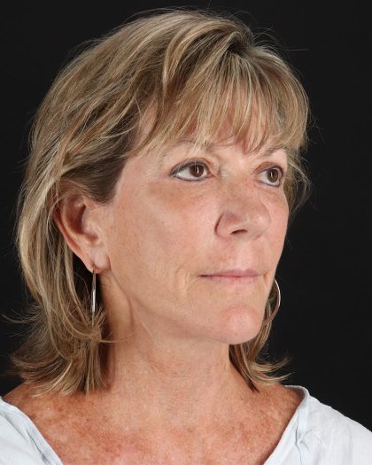 Facelift Before & After Patient #8948