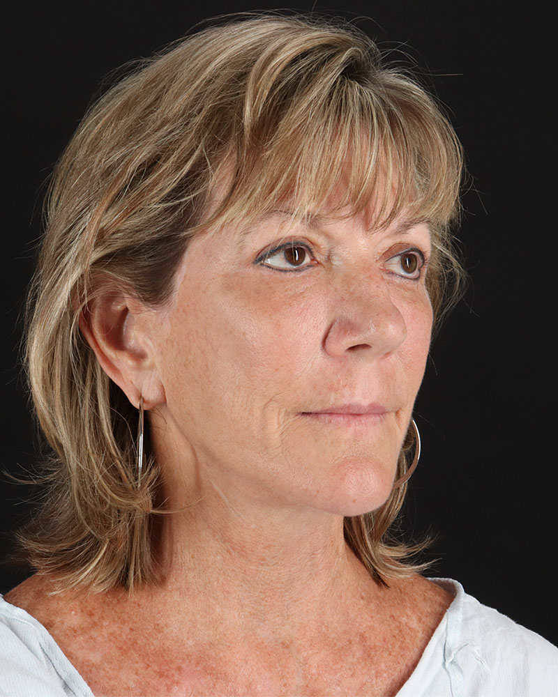 Facelift Before & After Patient #8948