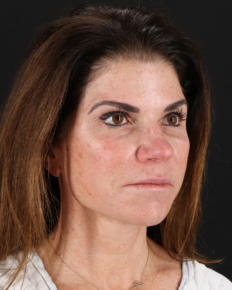 Facelift Before & After Patient #8949