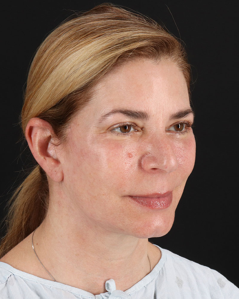 Lower Blepharoplasty Before & After Patient #8951