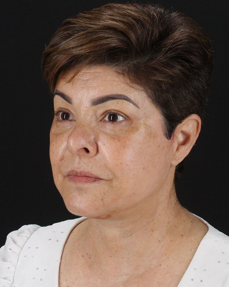 Facelift Before & After Patient #8952