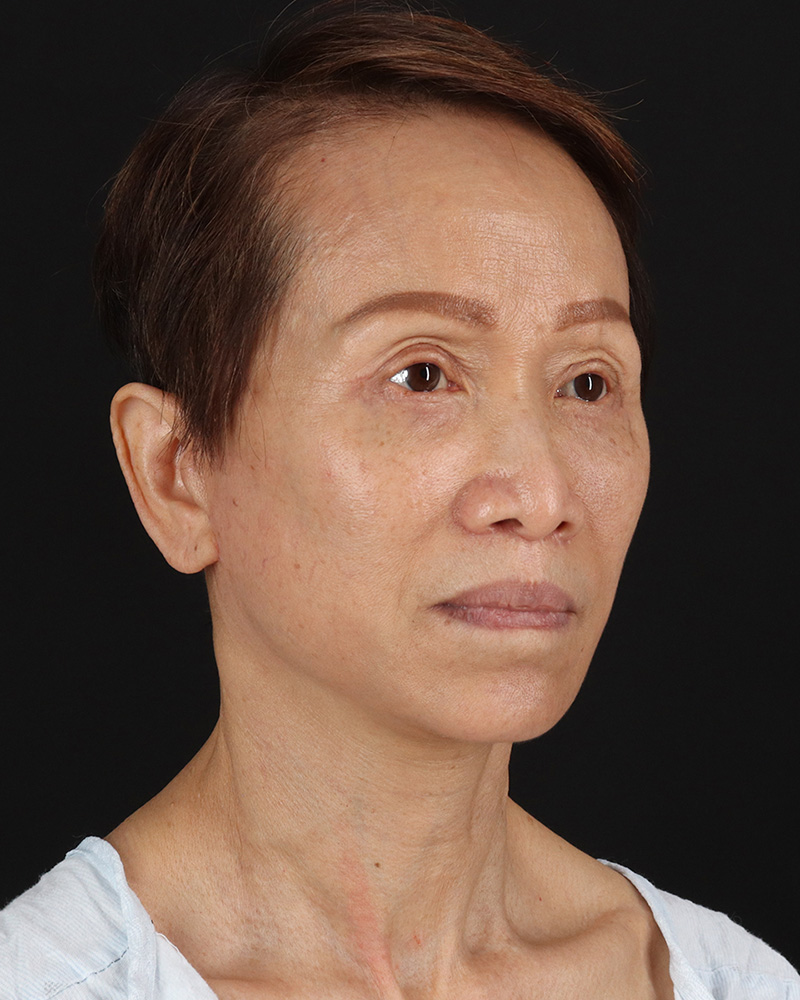Facelift Before & After Patient #8950
