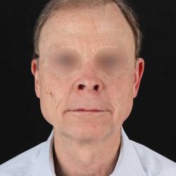 Facelift Before & After Patient #8945