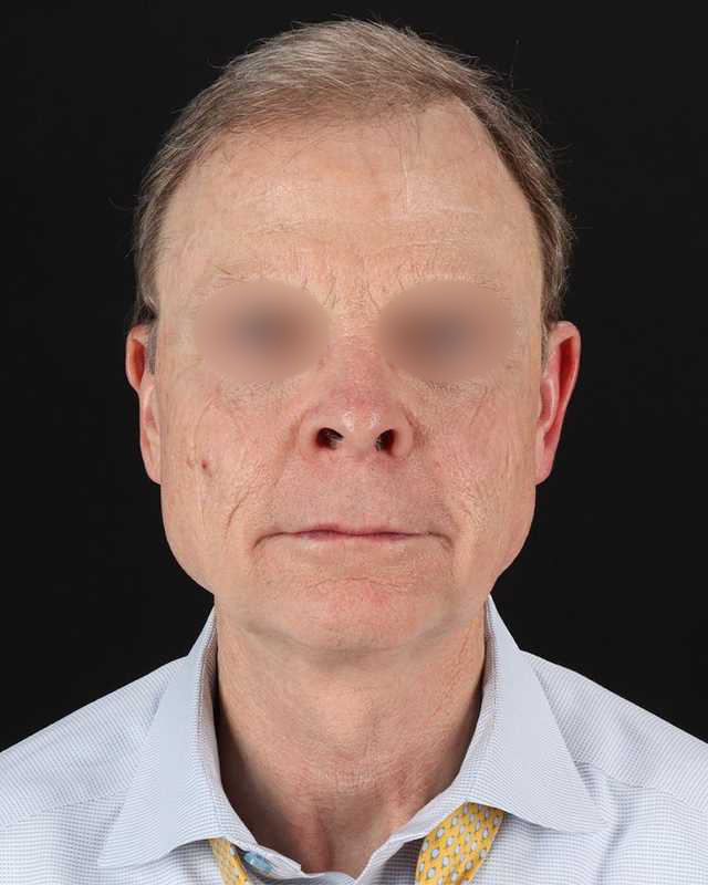 Facelift Before & After Patient #8945