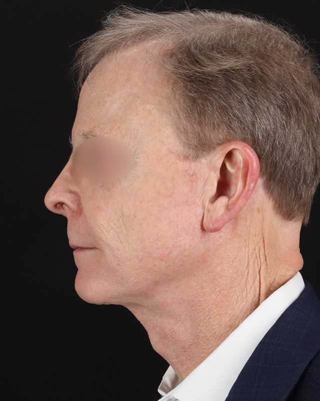 Facelift Before & After Patient #8945