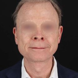 Facelift Before & After Patient #8945