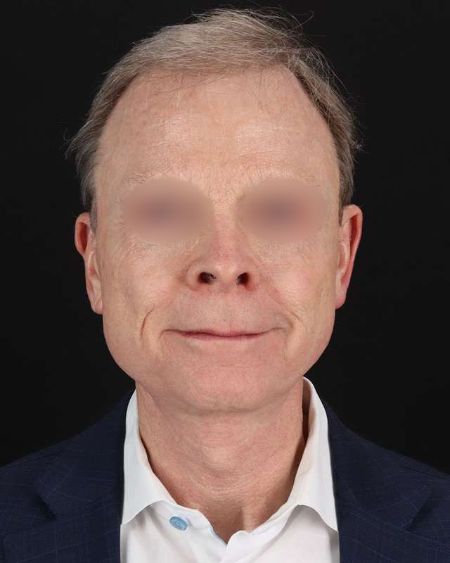 Facelift Before & After Patient #8945