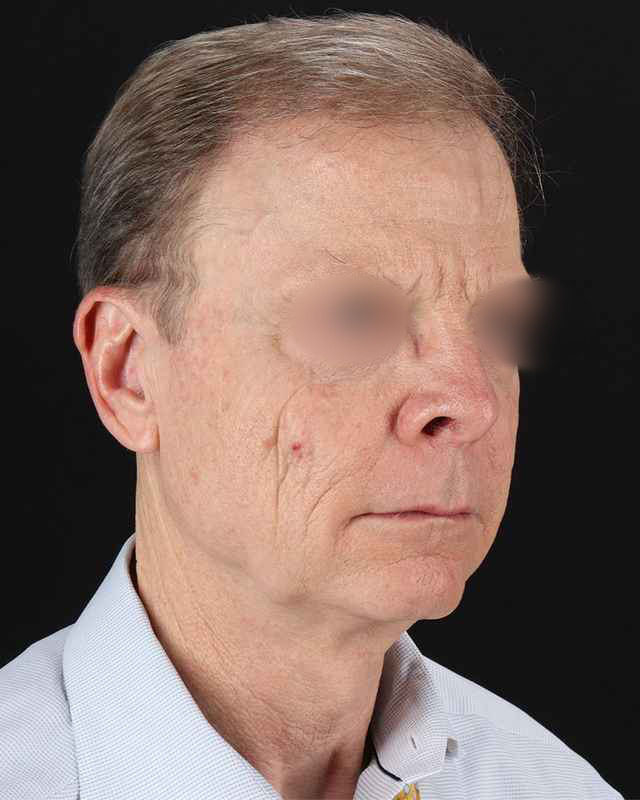 Facelift Before & After Patient #8945