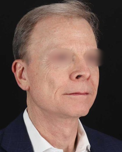 Facelift Before & After Patient #8945