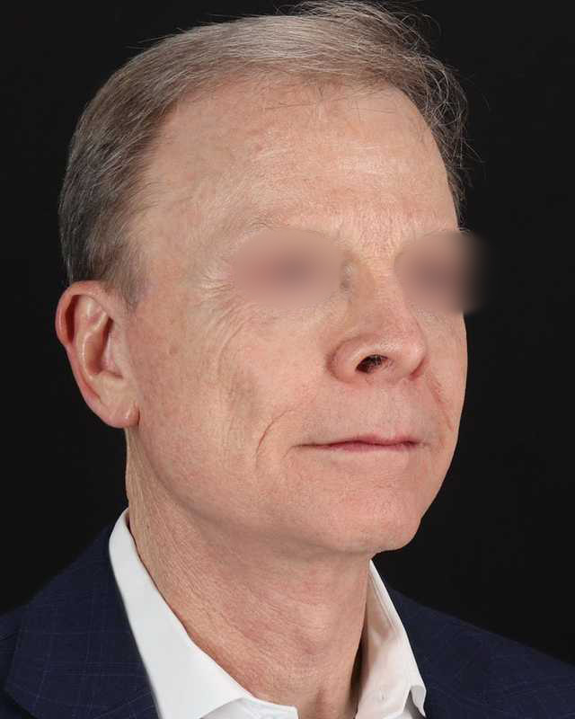 Facelift Before & After Patient #8945