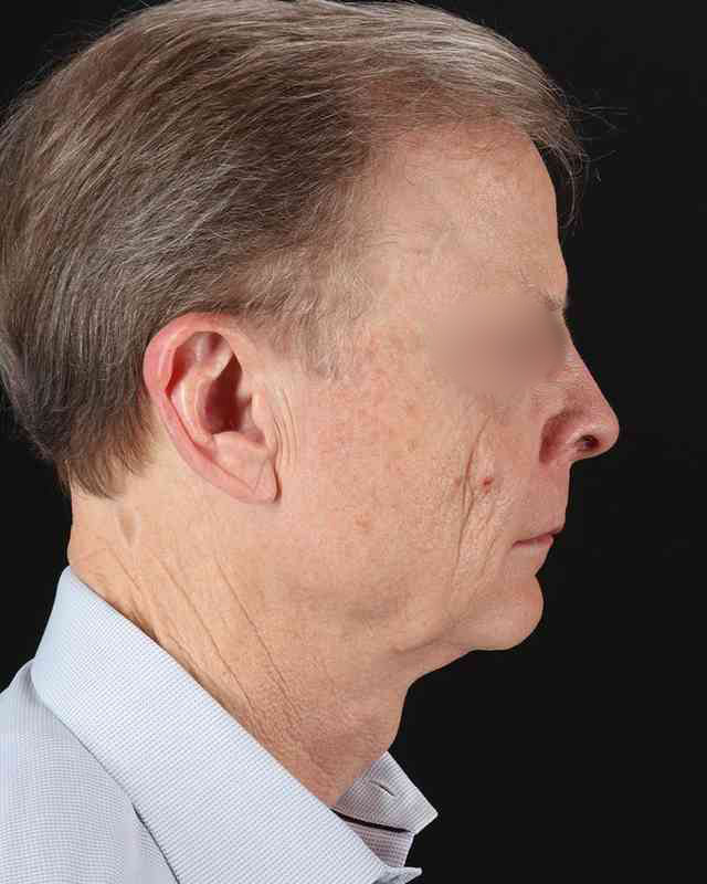 Facelift Before & After Patient #8945