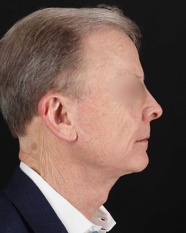 Facelift Before & After Patient #8945