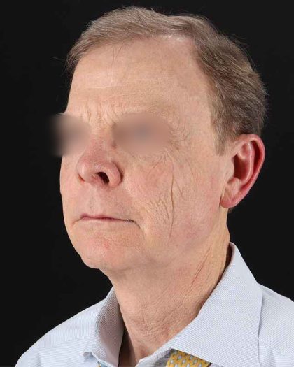 Facelift Before & After Patient #8945