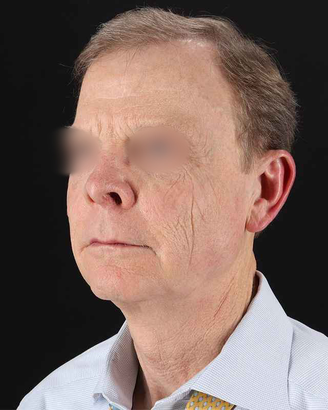 Facelift Before & After Patient #8945
