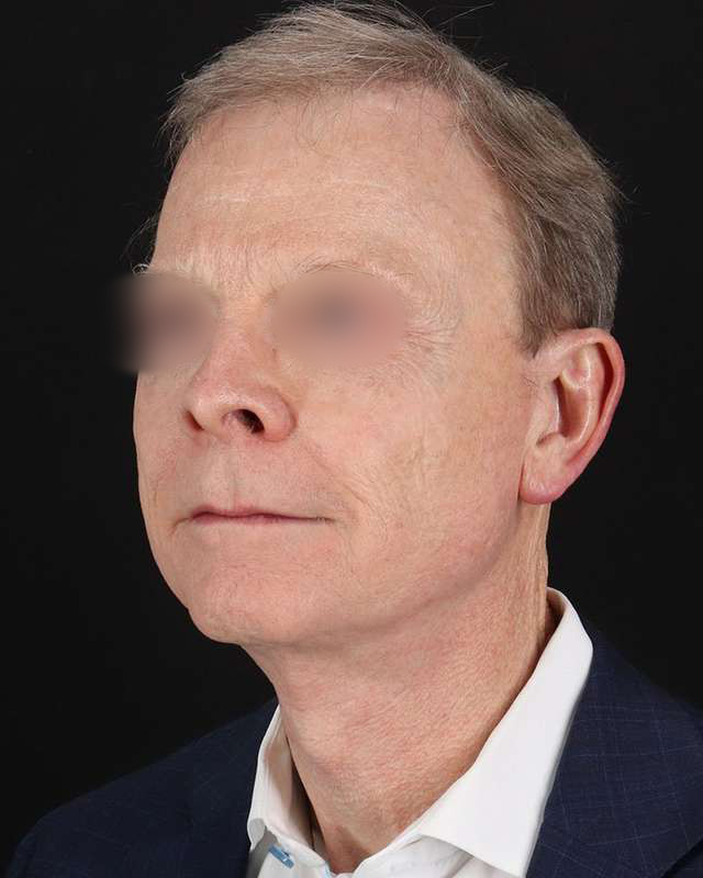 Facelift Before & After Patient #8945