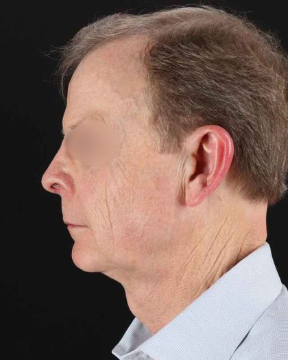 Facelift Before & After Patient #8945