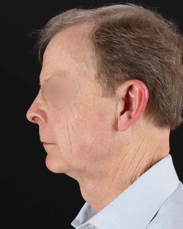 Facelift Before & After Patient #8945