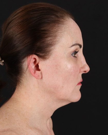 Facelift Before & After Patient #8943