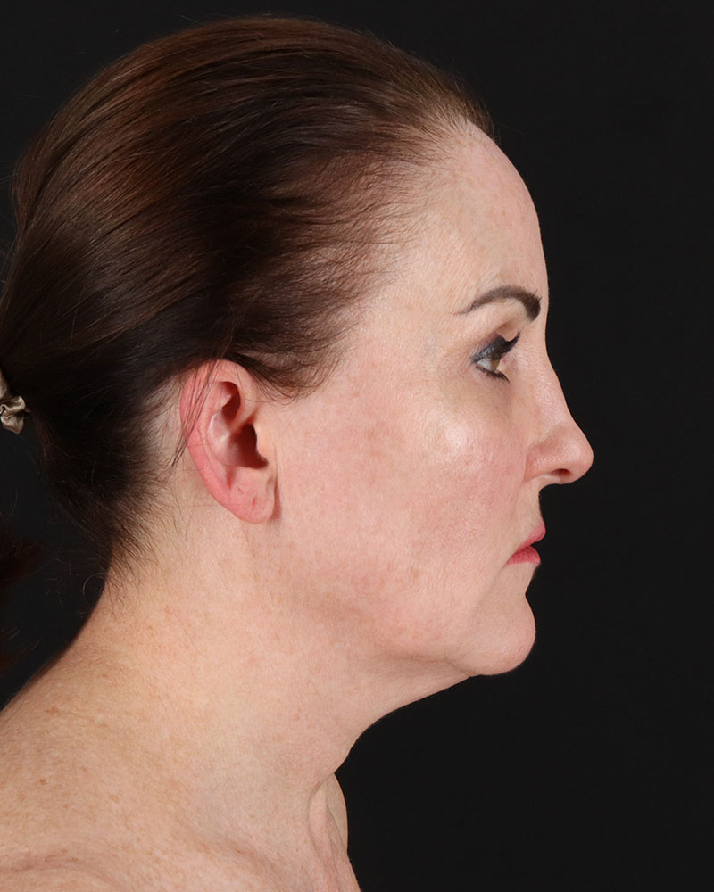 Facelift Before & After Patient #8943
