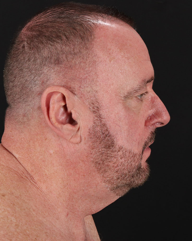Facelift Before & After Patient #8955