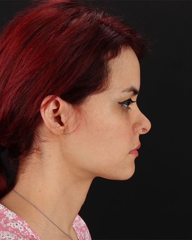 Mini Facelift Before & After Patient #8956