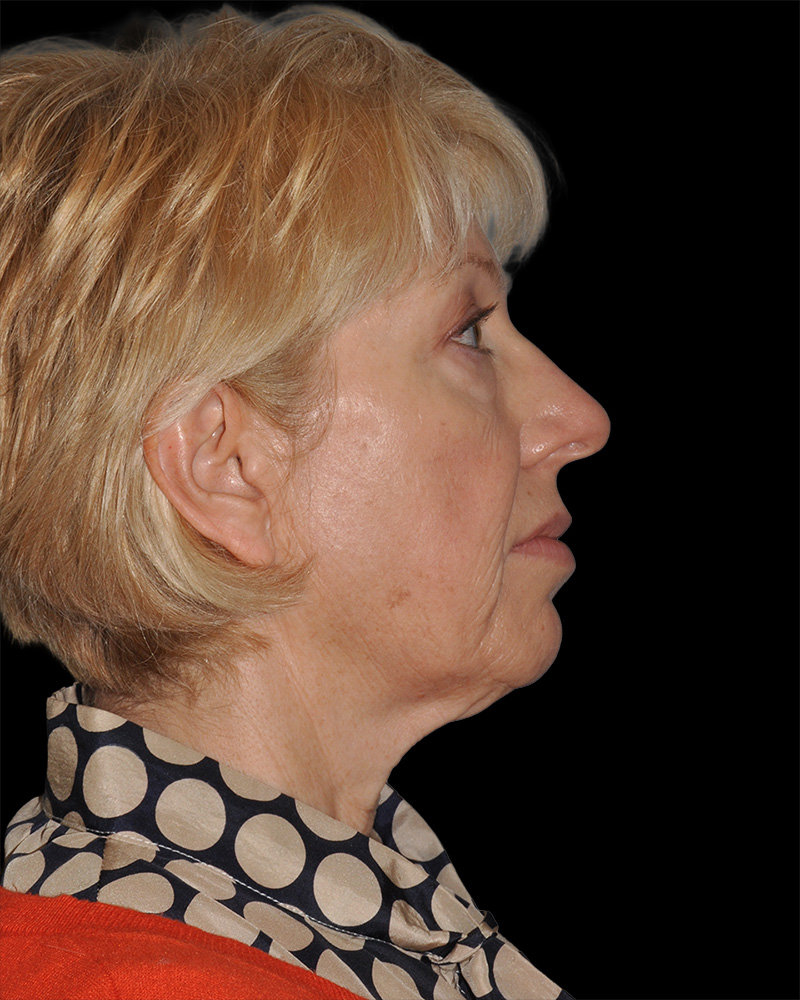 Facelift Before & After Patient #8958