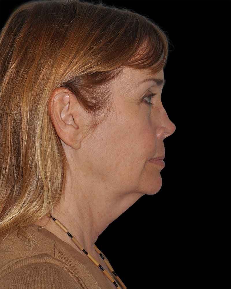 Facelift Before & After Patient #8959