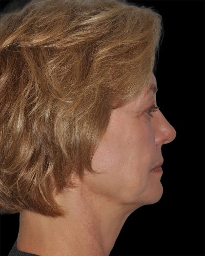 Facelift Before & After Patient #9131