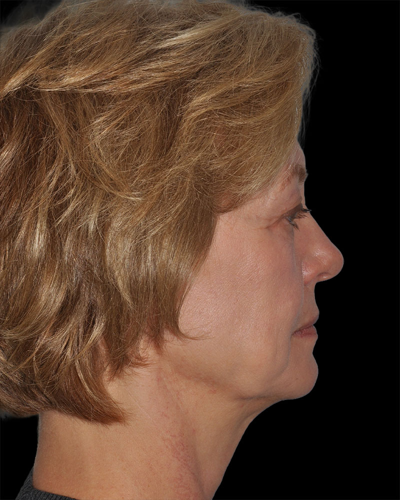 Facelift Before & After Patient #9131