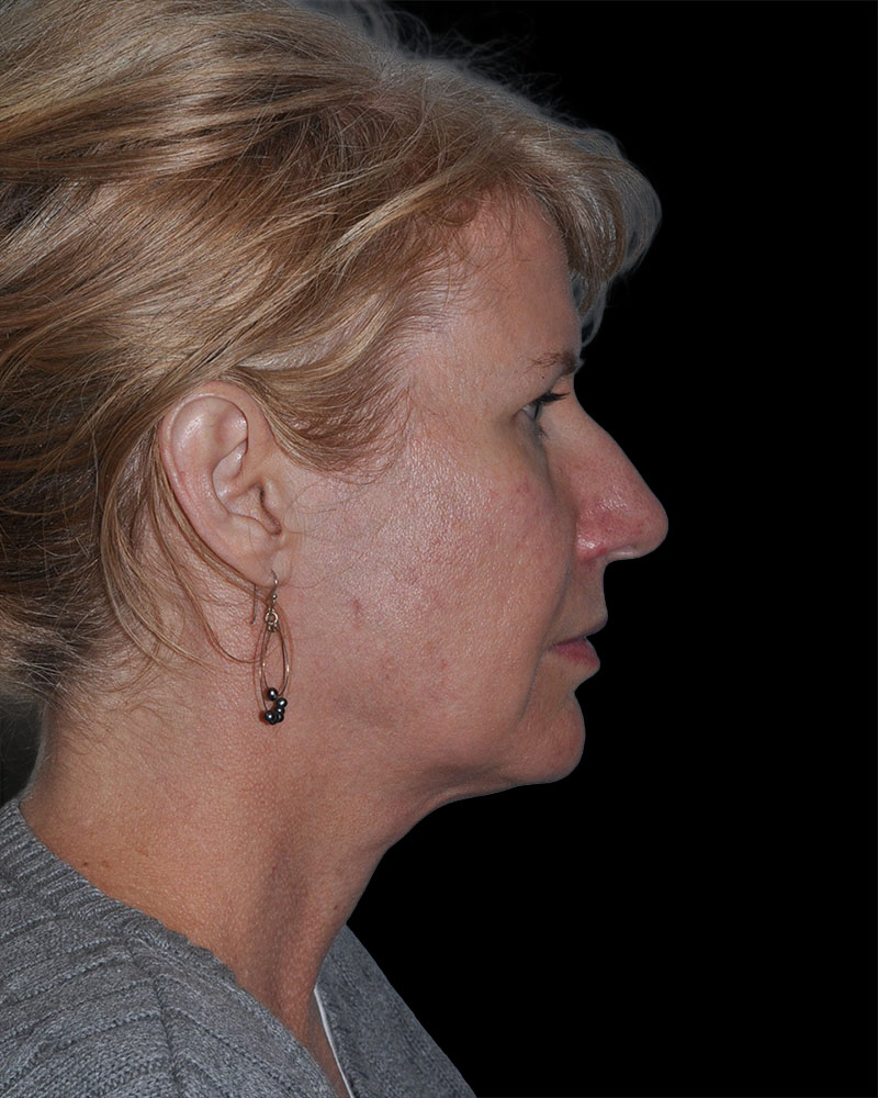 Facelift Before & After Patient #9135