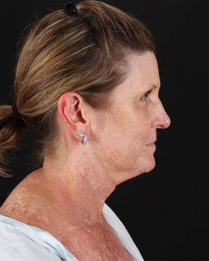 Facelift Before & After Patient #8944