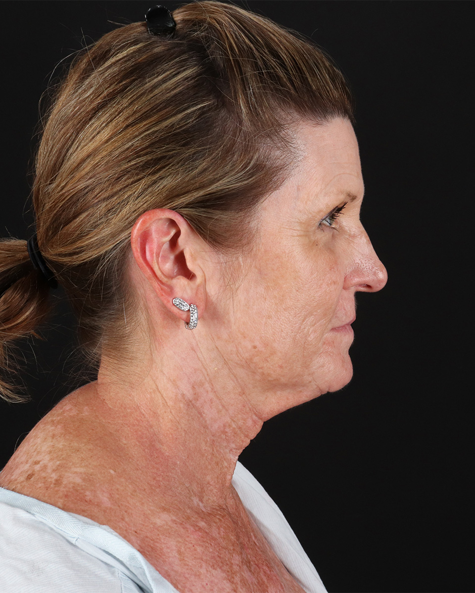 Facelift Before & After Patient #8944
