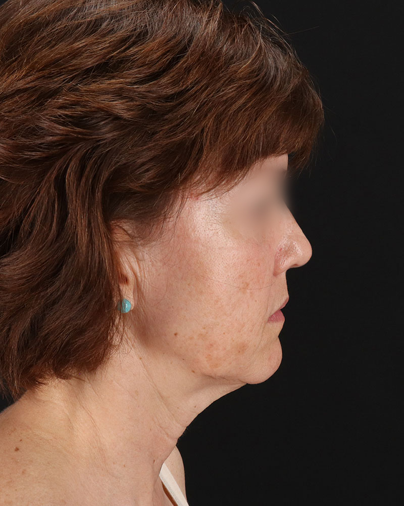 Facelift Before & After Patient #9173