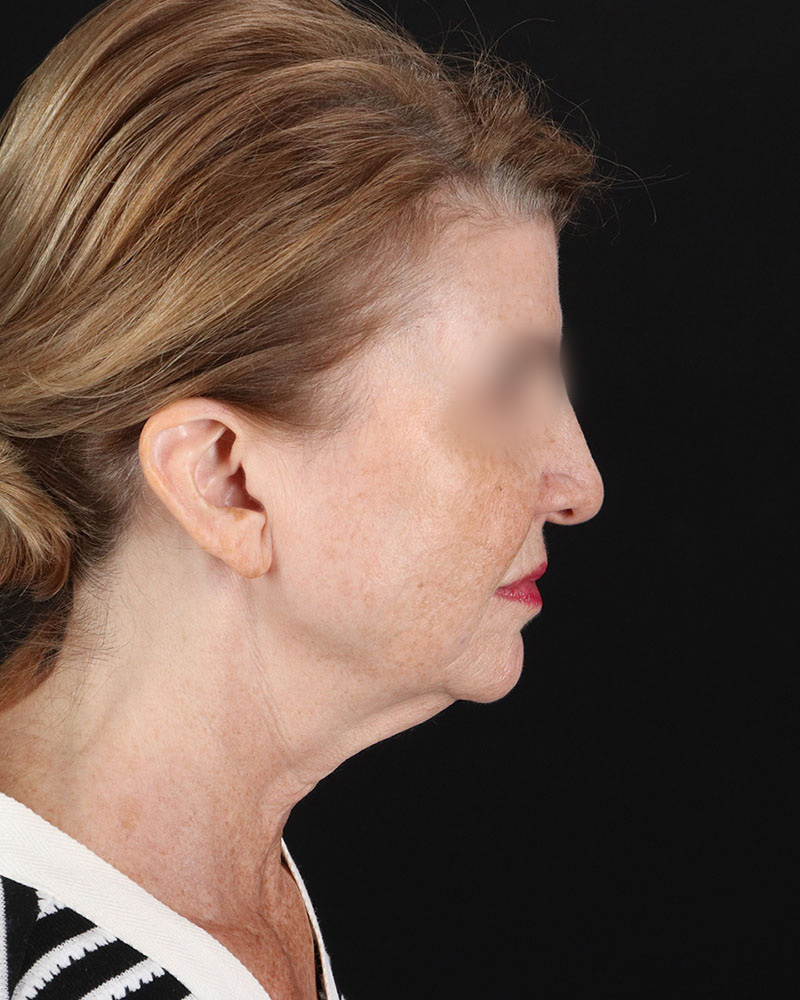 Facelift Before & After Patient #9140