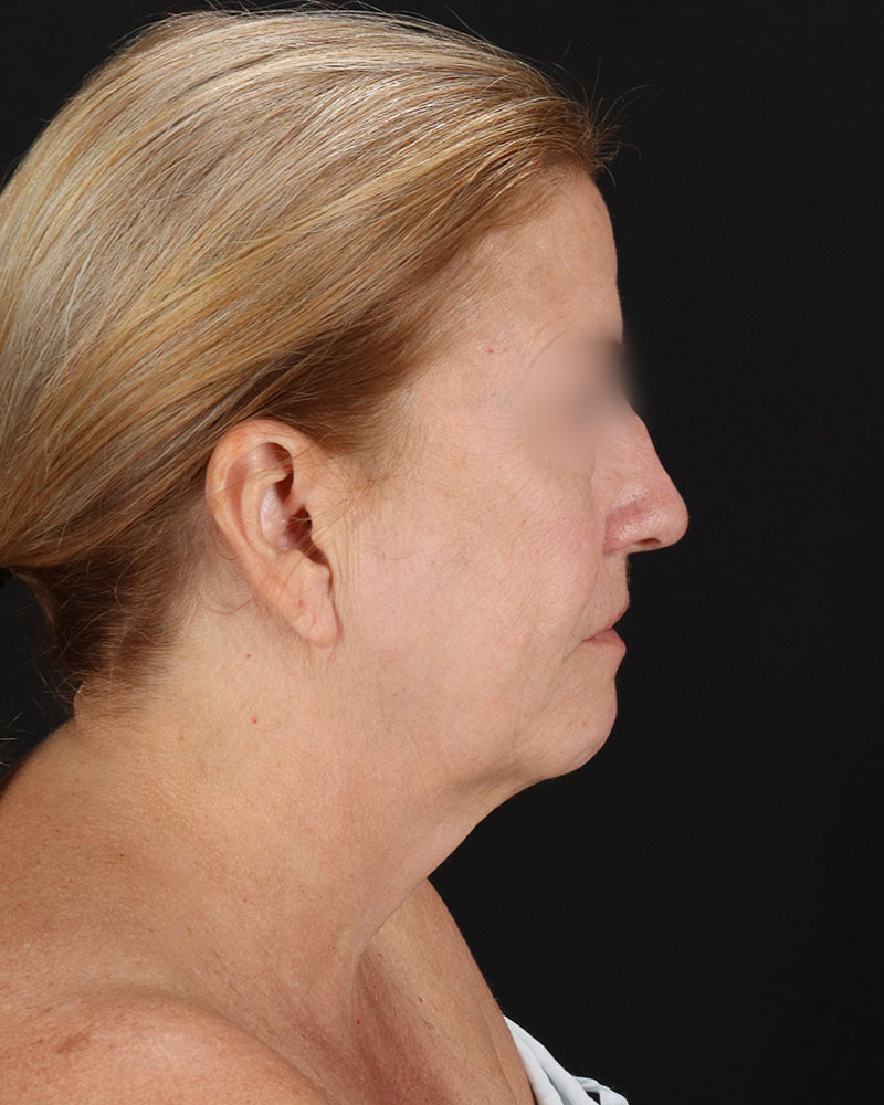 Facelift Before & After Patient #8957