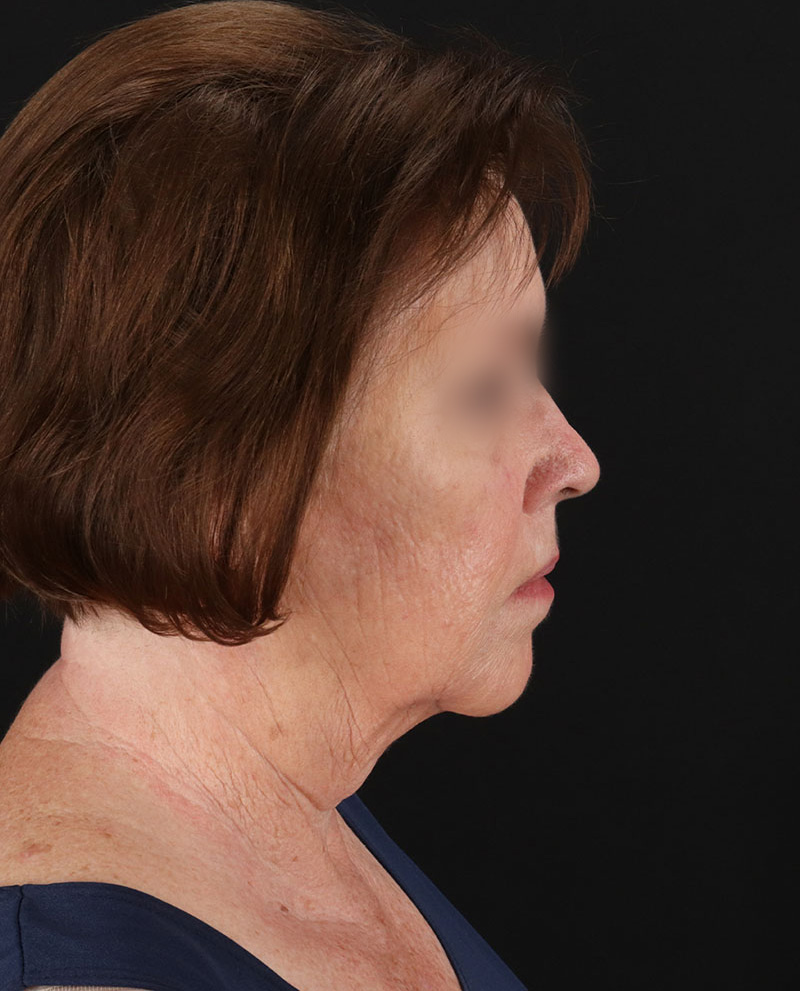 Facelift Before & After Patient #8954