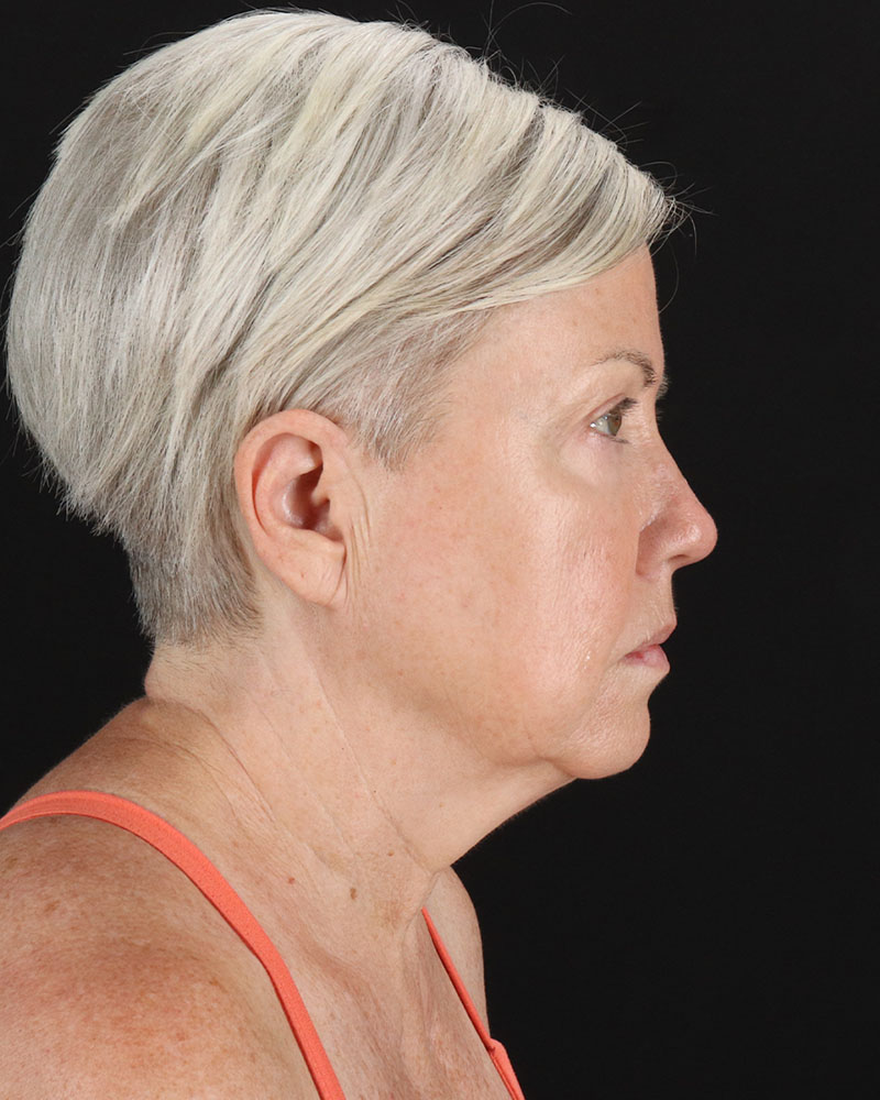 Facelift Before & After Patient #8946