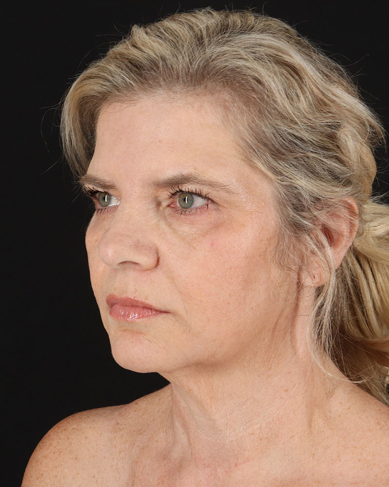 Facelift Before & After Patient #8947