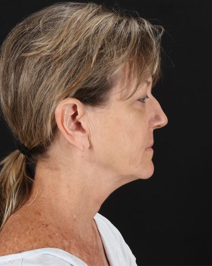 Facelift Before & After Patient #8948