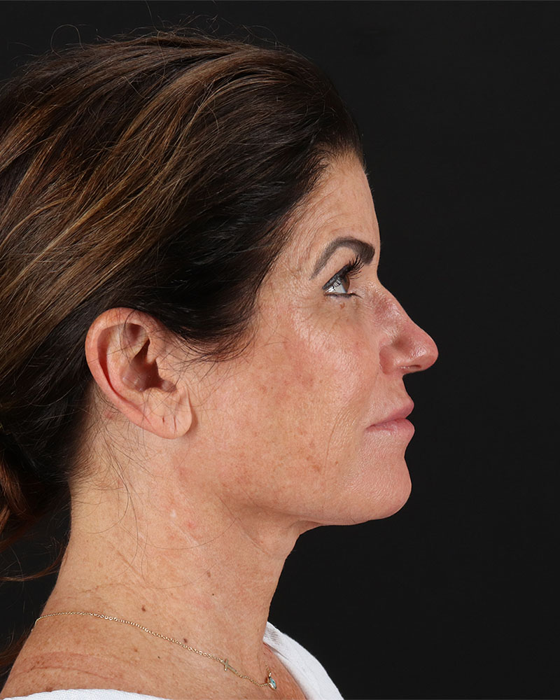 Facelift Before & After Patient #8949